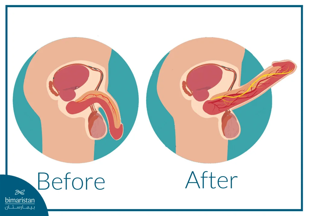 Erectile Dysfunction: Causes, Diagnosis And Treatment 2 An Image Illustrating The Effect Of Erectile Dysfunction Treatment.