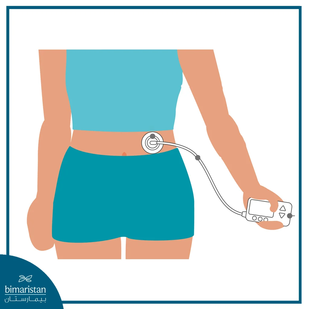 An Image Illustrating The Placement Of An Insulin Pump On The Body.