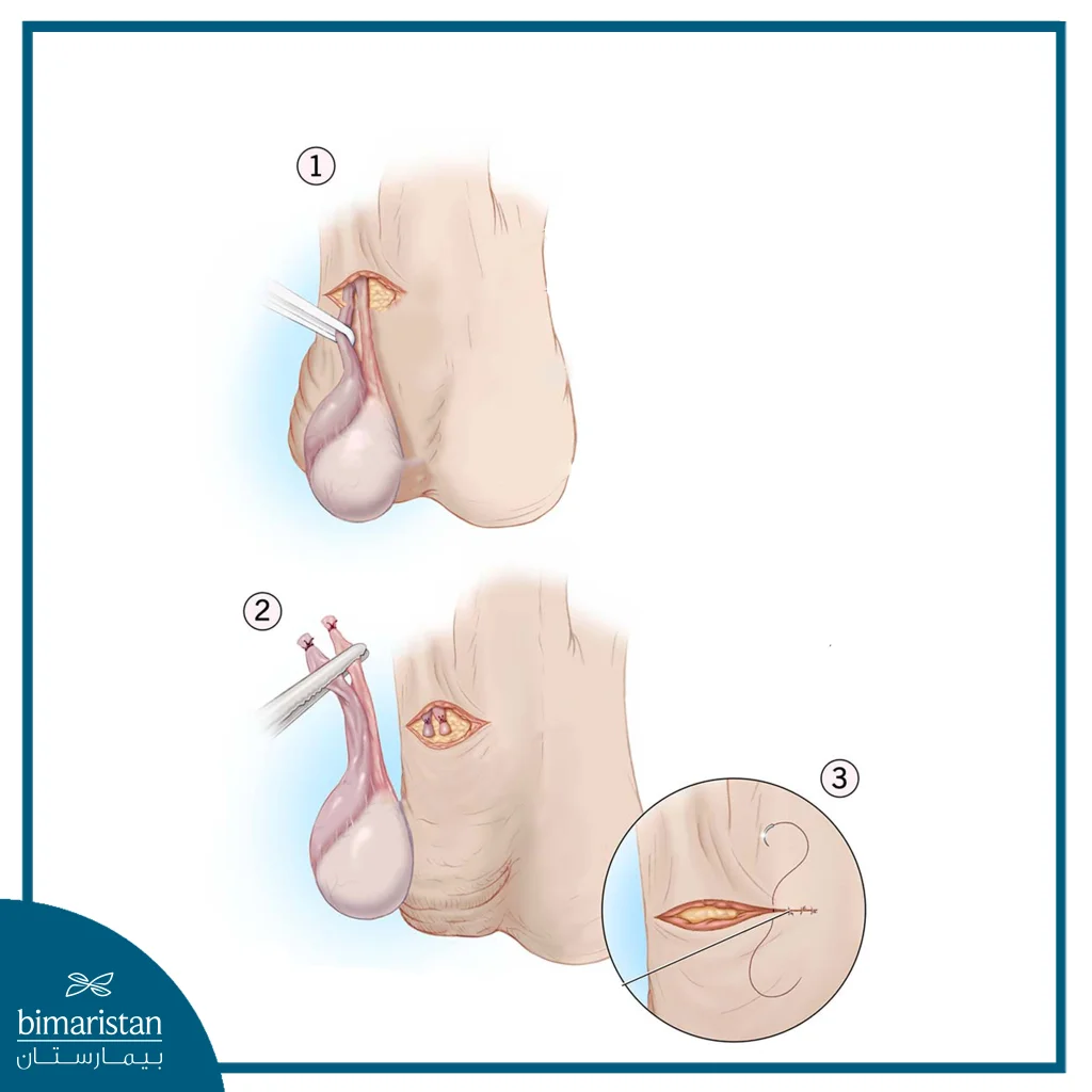 An Image Illustrating The Surgical Castration Procedure.