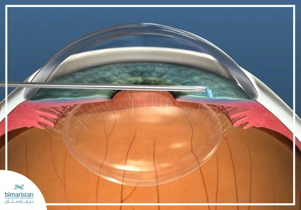 An Image Showing How Femtolaser Cataract Surgery Is Performed