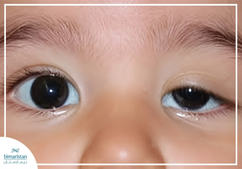 An Image Showing Ptosis In Children