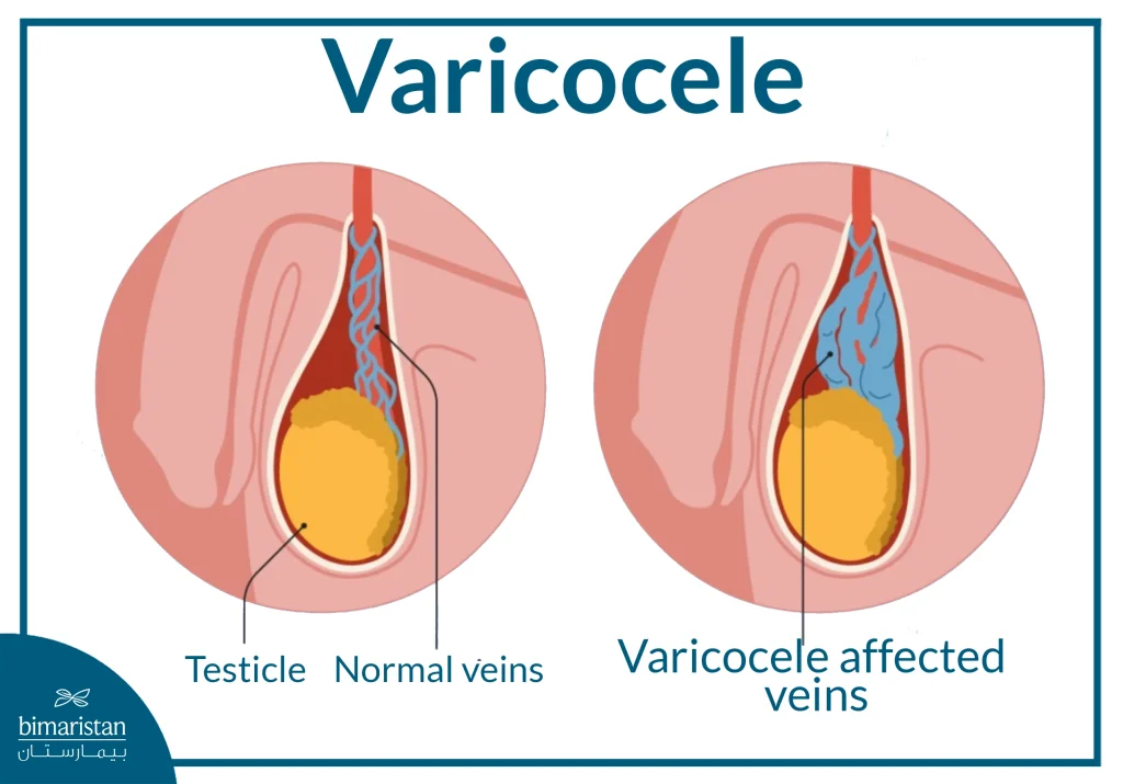 An Image Showing The Difference Between A Healthy Testicle And A Varicocele
