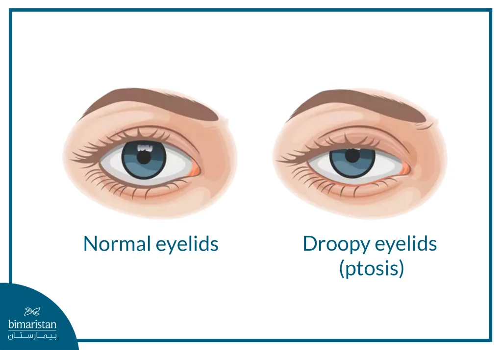 An Image Showing The Difference Between A Normal Eye And An Eye Affected By Ptosis