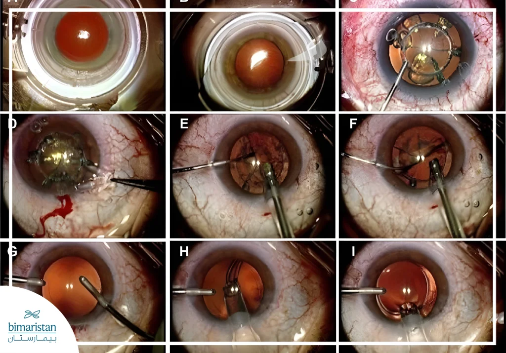 An Image Showing The Steps Of Femtolaser Cataract Surgery