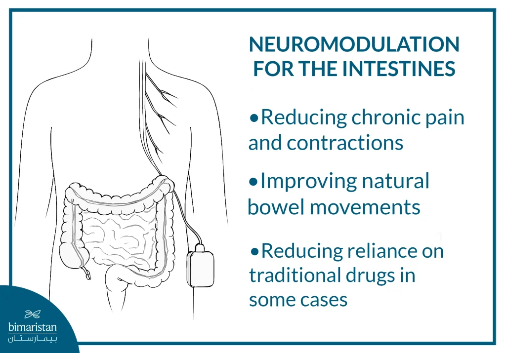 Ibs Treatment Methods: Symptoms And The Latest Treatments 4 An Image Showing The Treatment Of Ibs Through Neuromodulation Of The Intestines