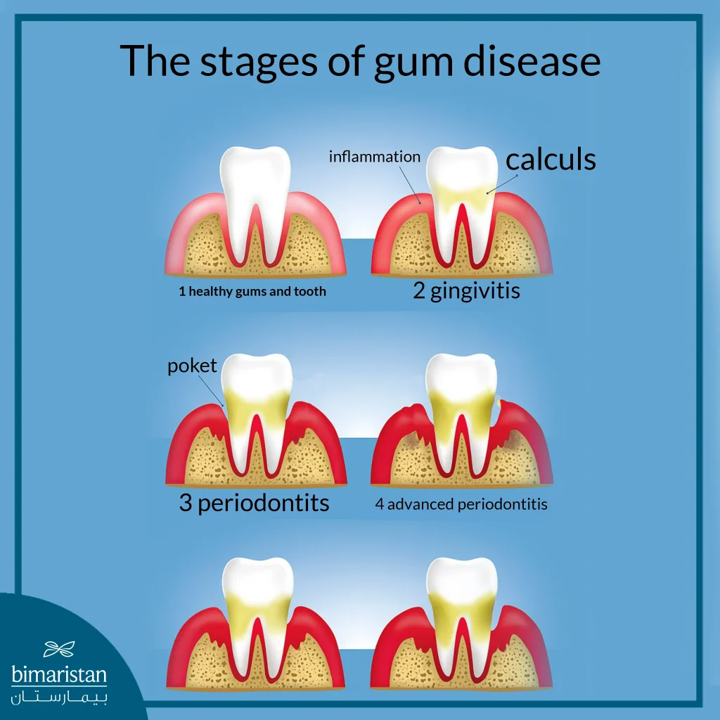 Causes Of Bleeding Gums: A Simple Sign Or A Warning Sign Of A Serious Illness 2 An Illustration Showing The Stages Of Gingivitis