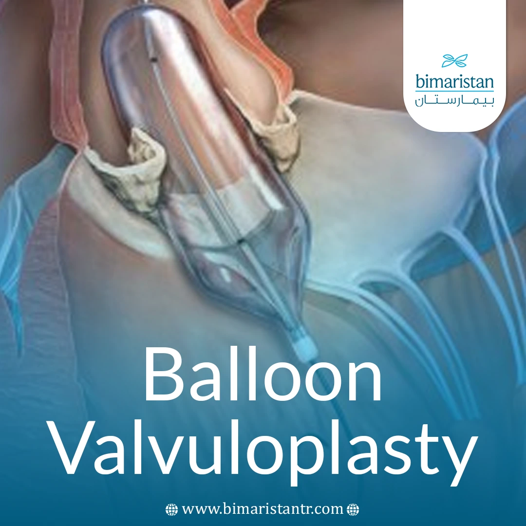 Understanding Balloon Valvuloplasty: Safe Treatment For Heart Valve Disorders 35 Balloon Valvuloplasty