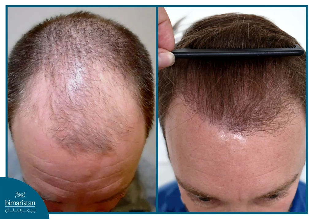 Nano Hair Transplant: Advanced Technology For Natural Results And Maximum Density 3 Before And After Comparison Using Nano Hair Transplant Technique.