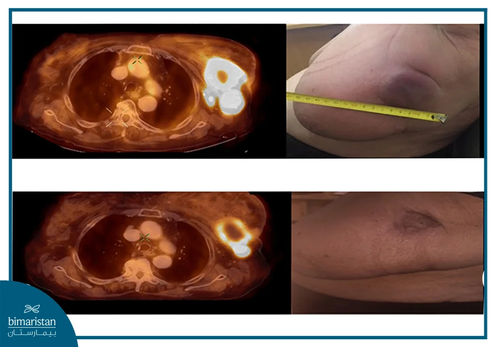 Images Before And After Radiation Therapy Showing Tumor Shrinkage And Improved Skin Condition