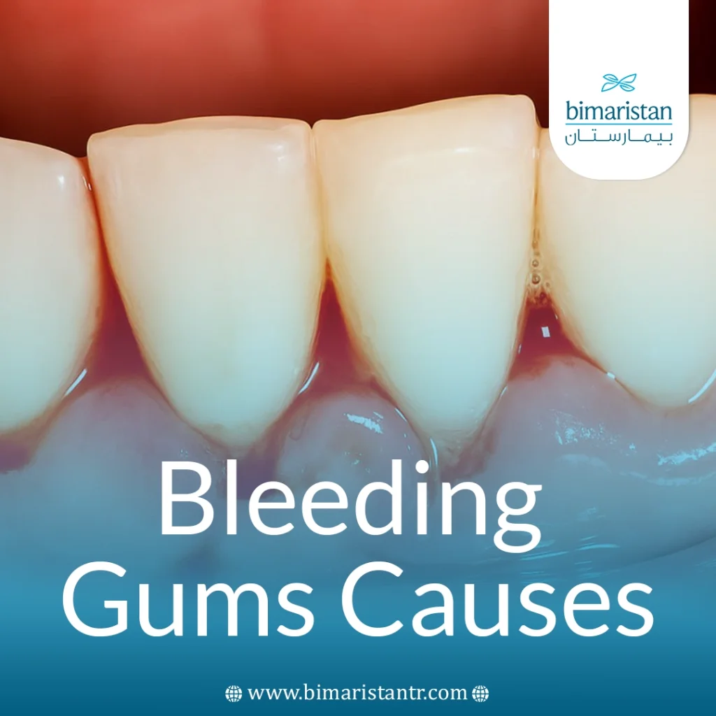 Causes Of Bleeding Gums: A Simple Sign Or A Warning Sign Of A Serious Illness 5 Causes Of Bleeding Gums
