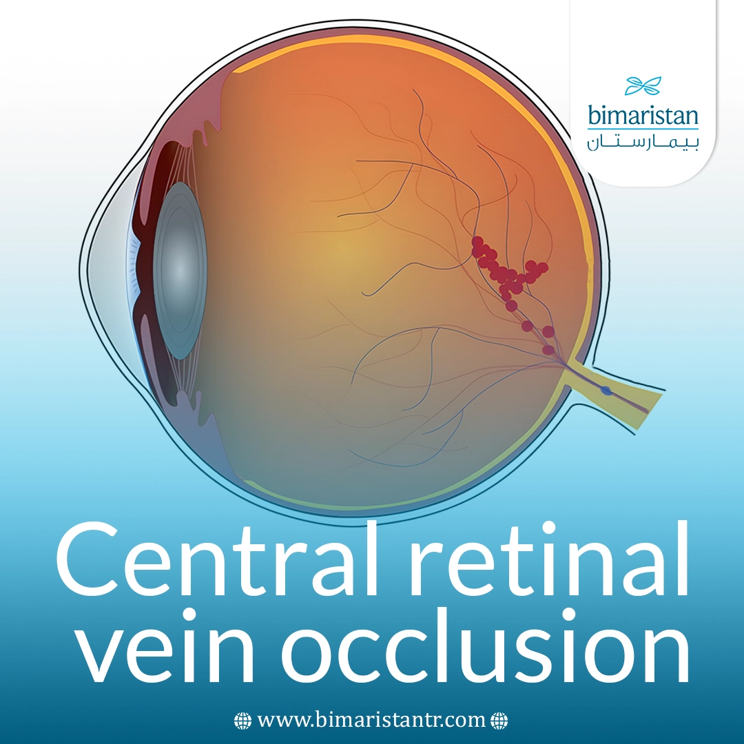 Central Retinal Vein Occlusion: Causes, Symptoms, And Modern Treatments 2 Central Retinal Vein Occlusion: Causes, Symptoms, And Modern Treatments