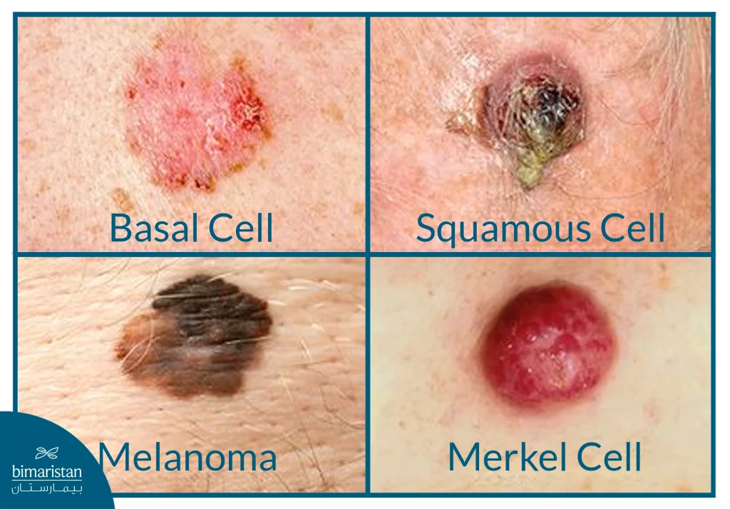 Clinical Image Of Skin Cancer Types