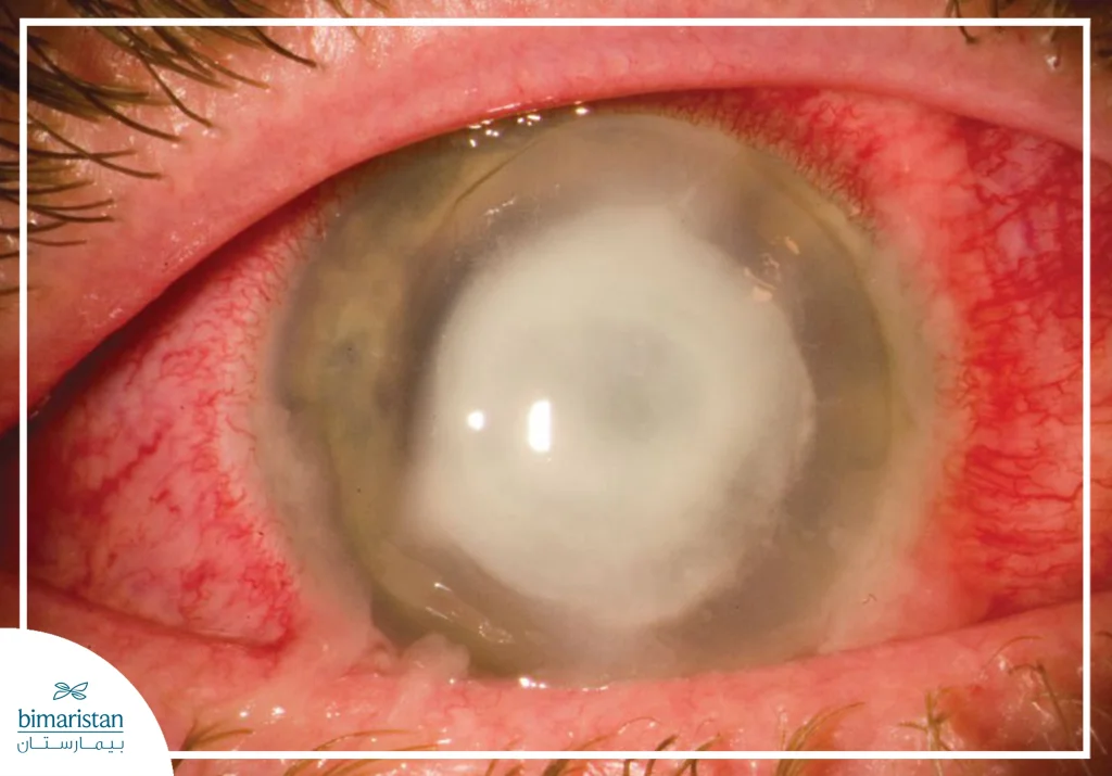 Keratitis: Discover Its Causes, Symptoms, And How It’s Treated 3 Close-Up Image Showing Severe Keratitis With A Central Corneal Ulcer And Eye Redness