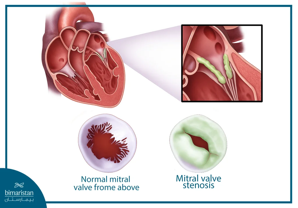 Comparison Between Normal And Stenotic Mitral Valve