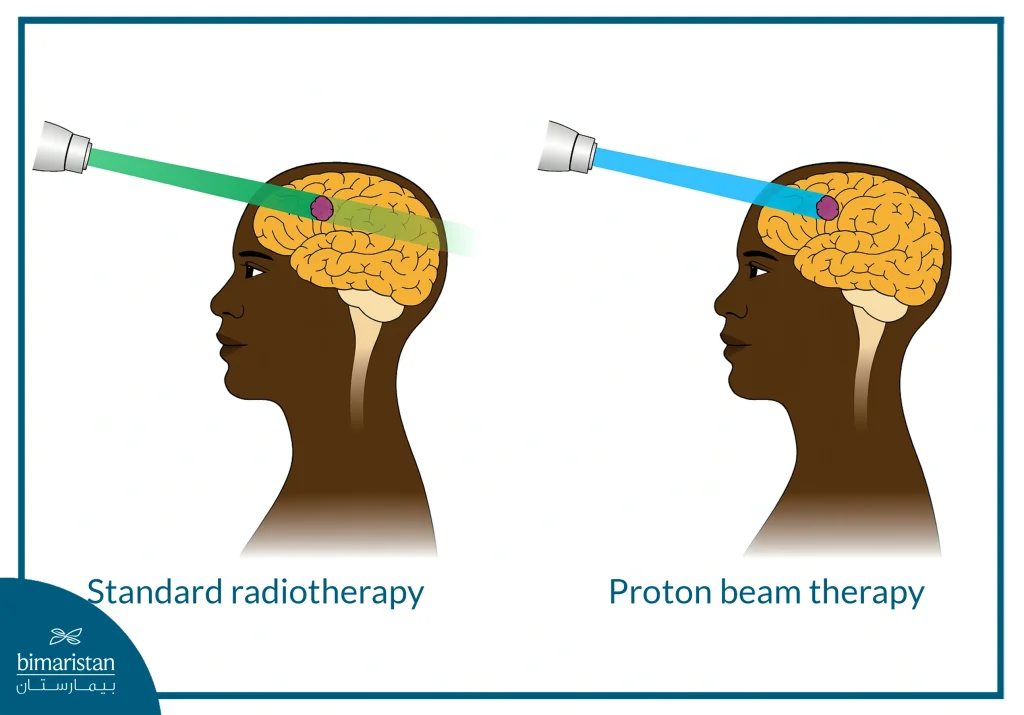 Proton Therapy: State-Of-The-Art Cancer Treatment With High Precision And Fewer Side Effects 3 Comparison Of Standard Radiotherapy And Proton Therapy For Brain Tumors.