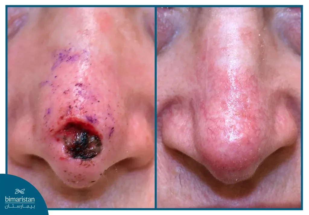 Comparison Of The Tumor Site Before And After Mohs Micrographic Surgery, Demonstrating Tissue Preservation And Clear Margins