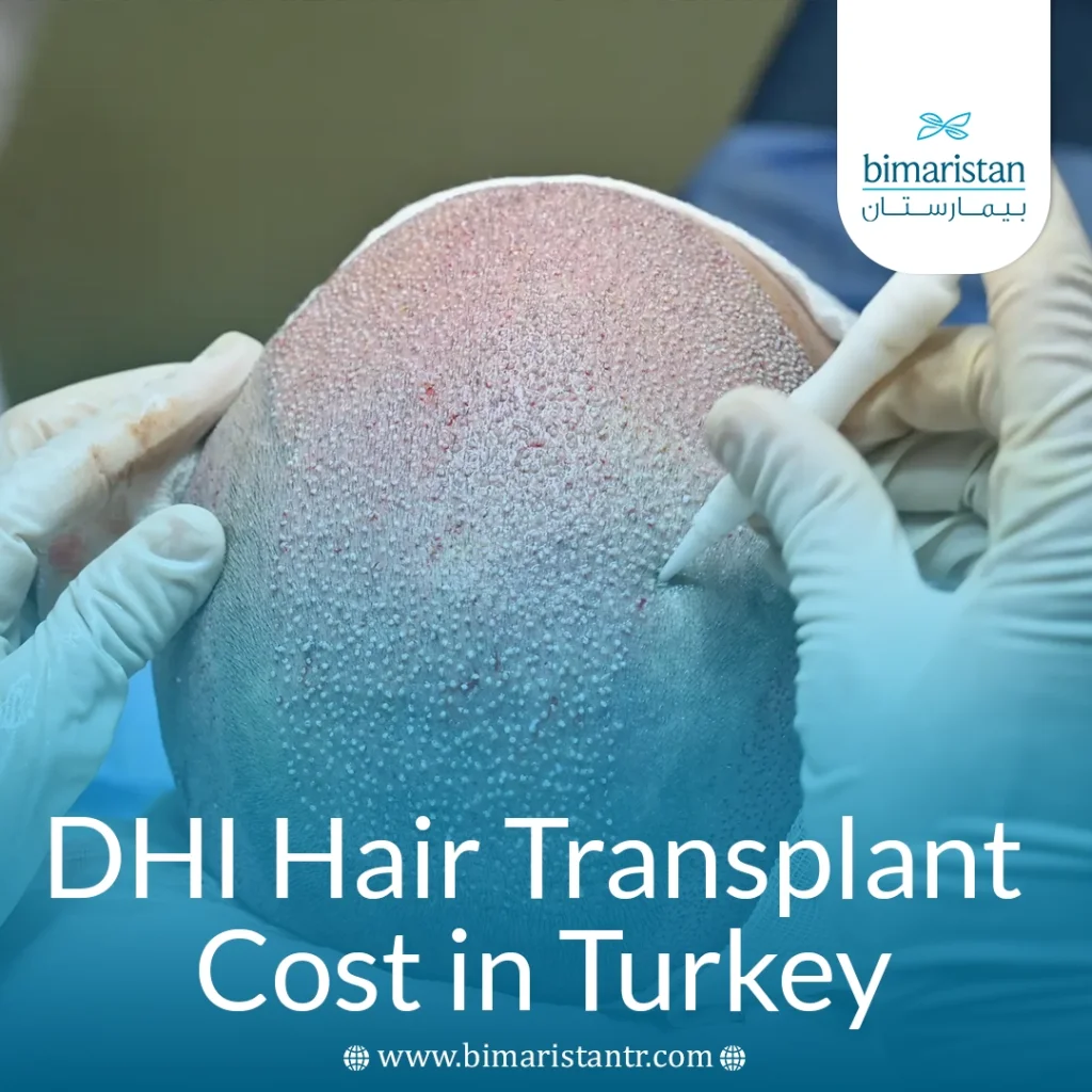 The Cost Of Dhi Hair Transplantation In Turkey