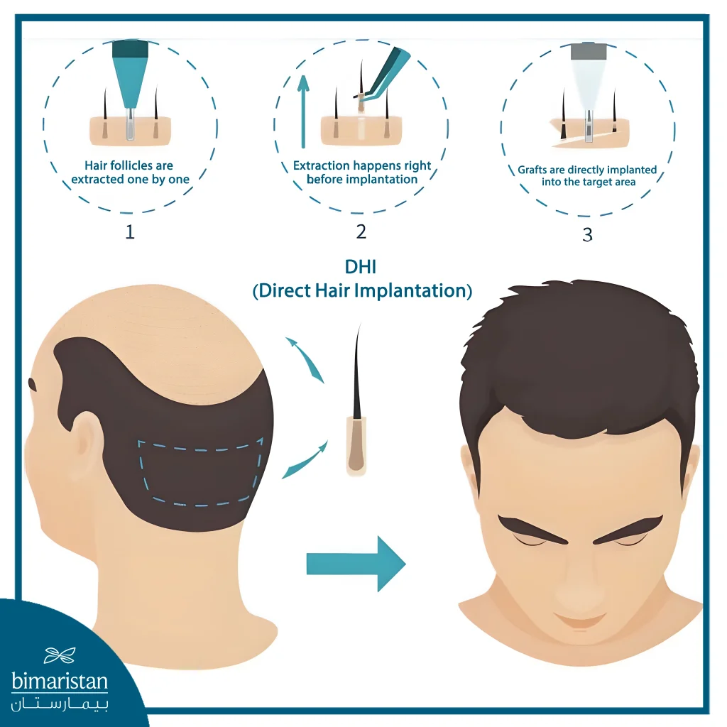 Dhi Hair Transplant Involves Directly Implanting Extracted Follicles Into The Scalp Without Prior Incisions.