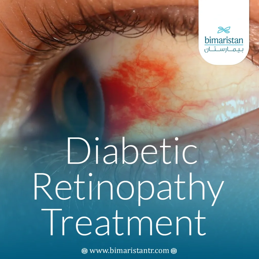 Diabetic Retinopathy Treatment In Turkey: Advanced Technologies For Vision Preservation 4 Diabetic Retinopathy Treatment