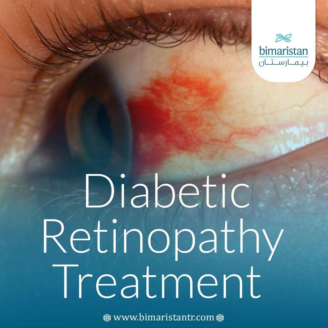Diabetic Retinopathy Treatment