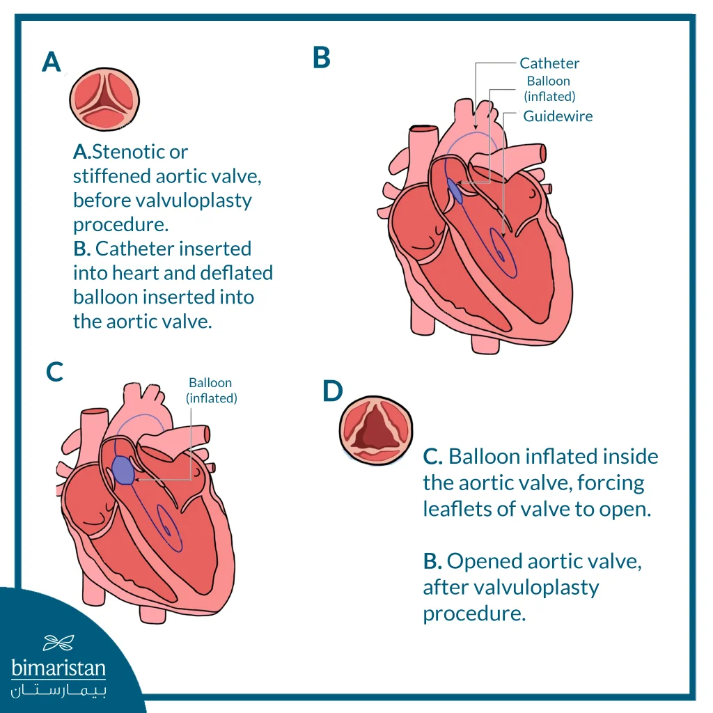Diagram Showing Stages Of Aortic Balloon Valvuloplasty Inside The Heart