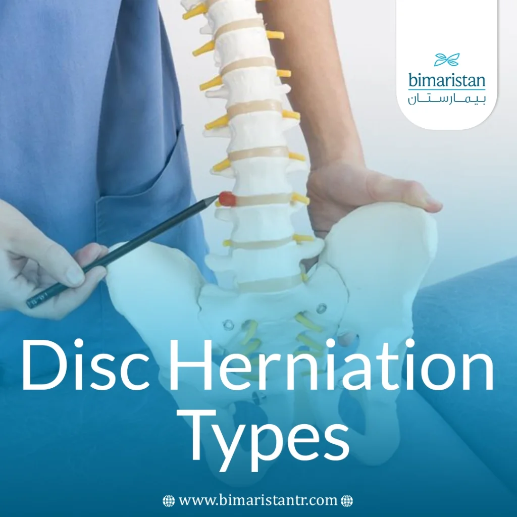 Disc Herniation Types: How Do Intervertebral Injuries Differ And Which Are The Most Serious? 6 Disc Herniation Types