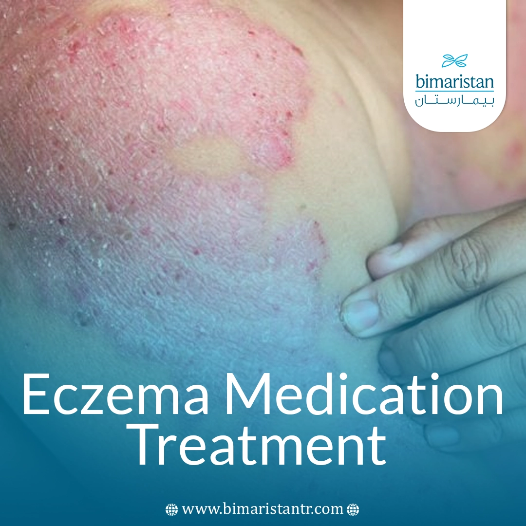 Eczema Medication Treatment