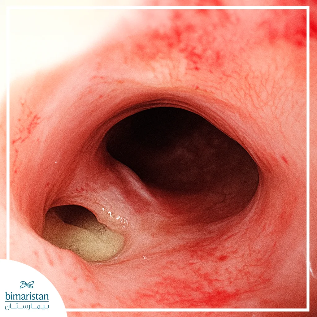 Endoscopic Image Showing A Clear Esophageal Perforation