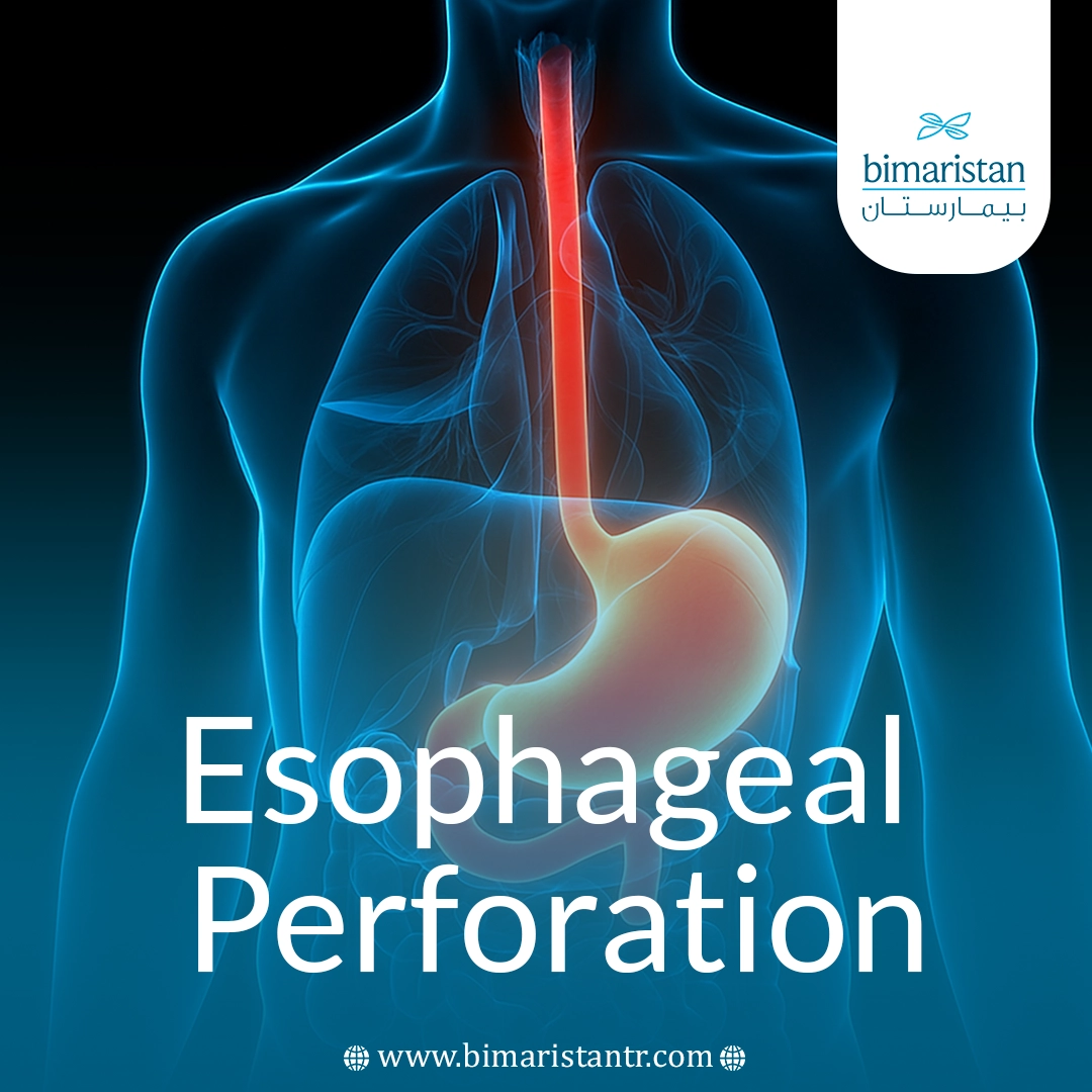 Esophageal Perforation