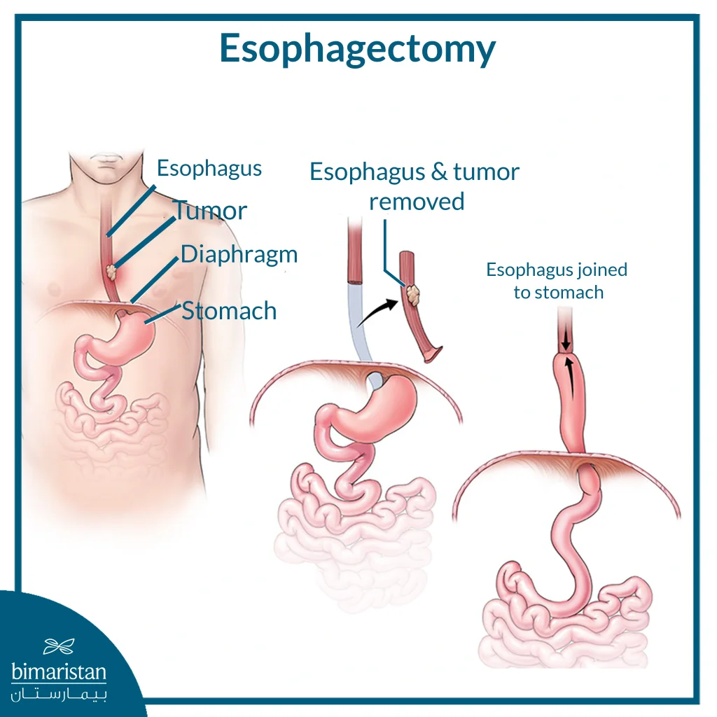 Esophageal Reflux Surgery