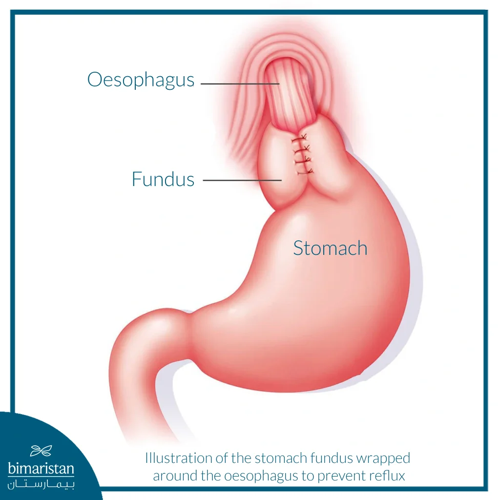 Gerd Surgery: When To Use It And What Are The Chances Of Success? 4 Esophageal Reflux Surgery