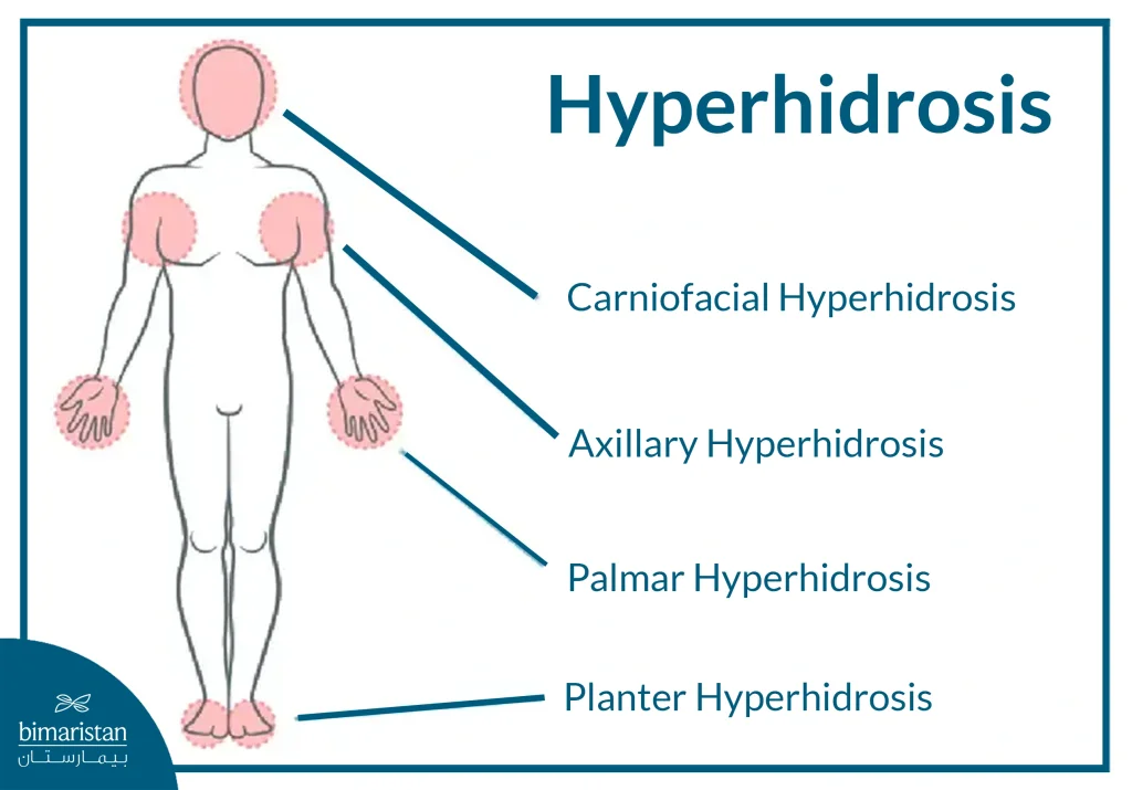 Hyperhidrosis Areas