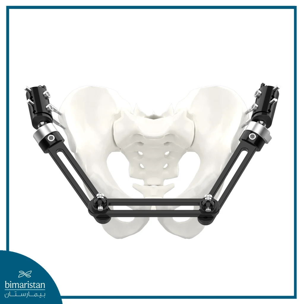 External Fixation Of The Pelvis
