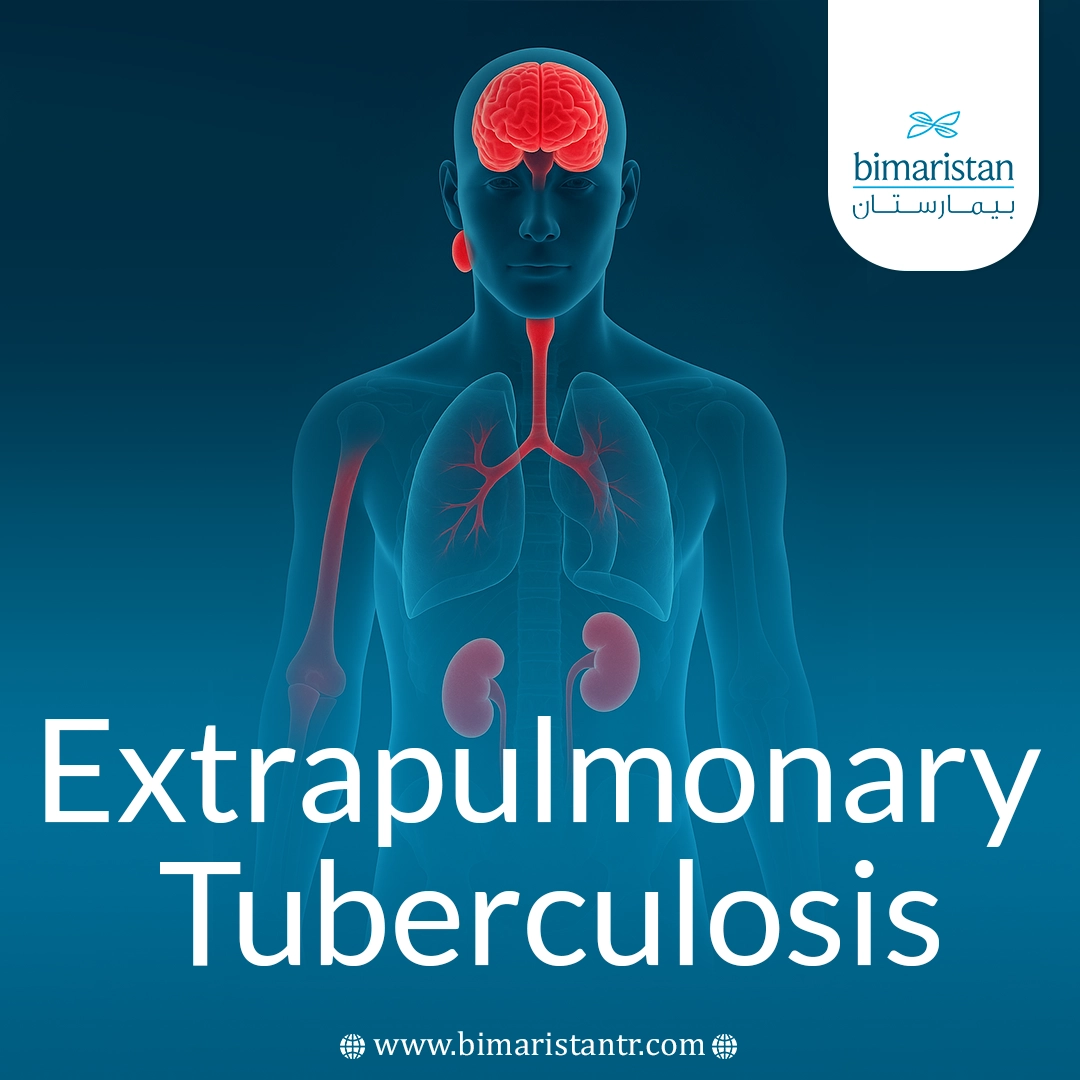 Extrapulmonary Tuberculosis