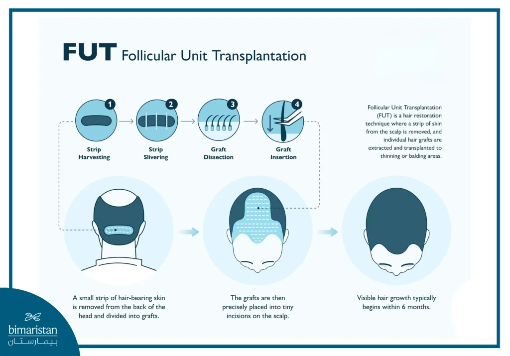 Fut Hair Transplant Cost In Turkey 2026: Prices, Procedure Steps &Amp; Expected Results 2 Fut Hair Transplant Is A Strip-Based Technique Where Hair Grafts Are Extracted From The Scalp And Implanted Into Bald Areas