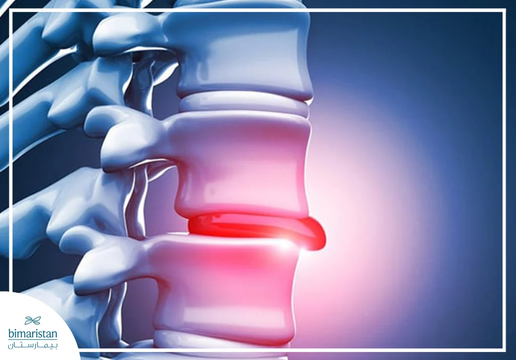 Herniated Disc One Of The Main Conditions Predisposing To Cervical Bone Spurs
