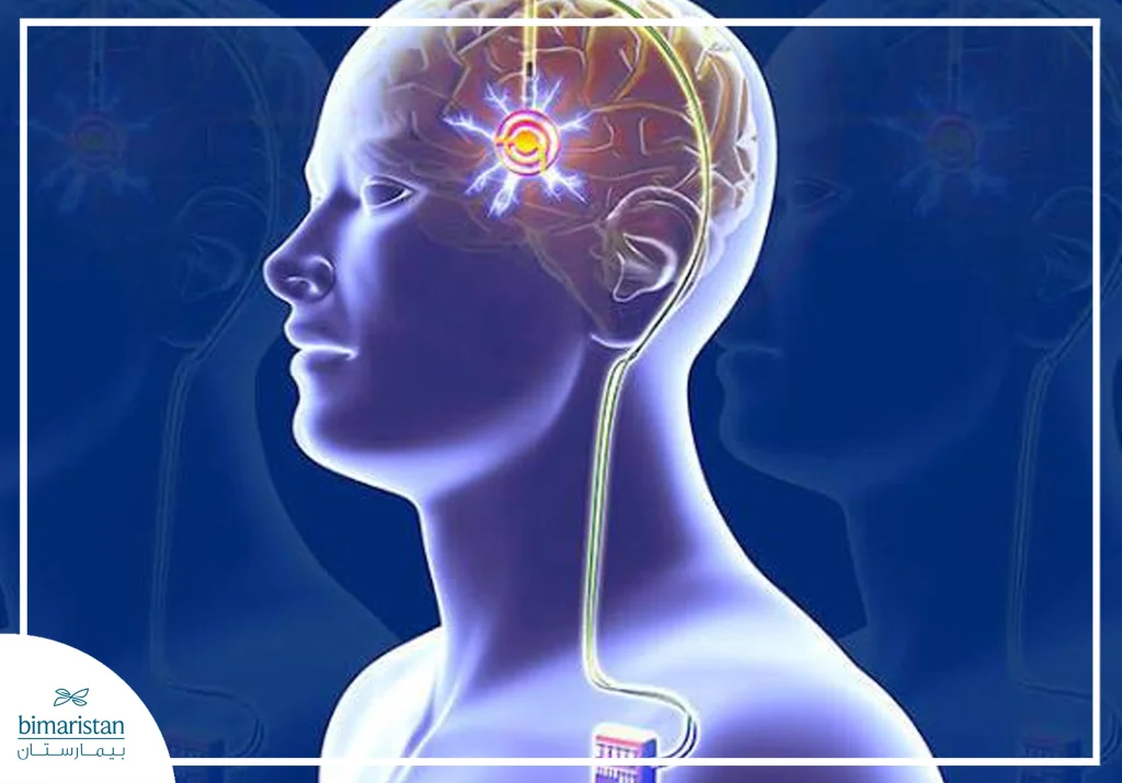 Image Of How To Get Parkinson'S Treatment With Deep Brain Stimulation