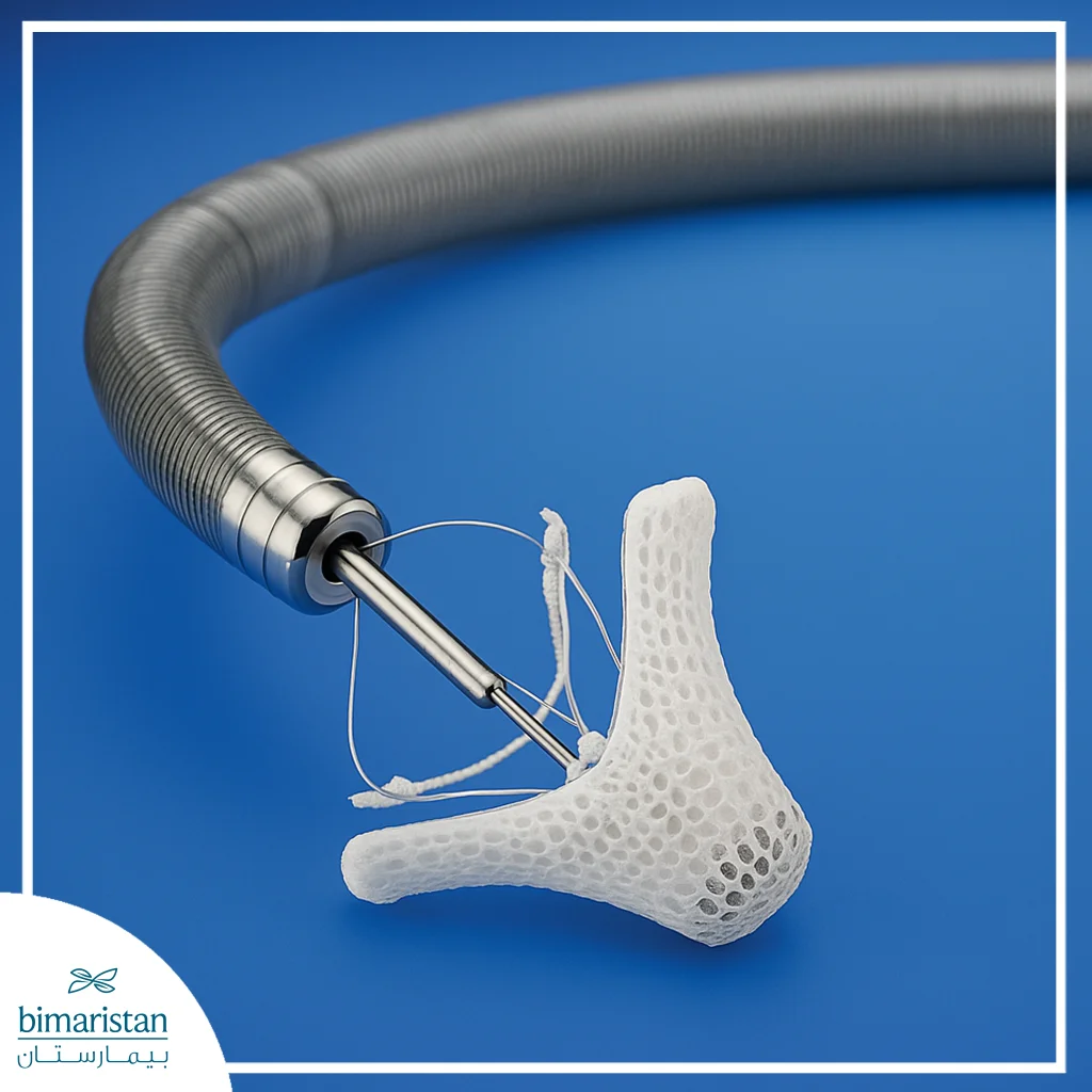 Mitraclip Procedure: A Minimally Invasive Solution For Mitral Valve Regurgitation 4 Image Of The Mitraclip Device Used For Mitral Valve Repair.image Of The Mitraclip Device Used For Mitral Valve Repair.