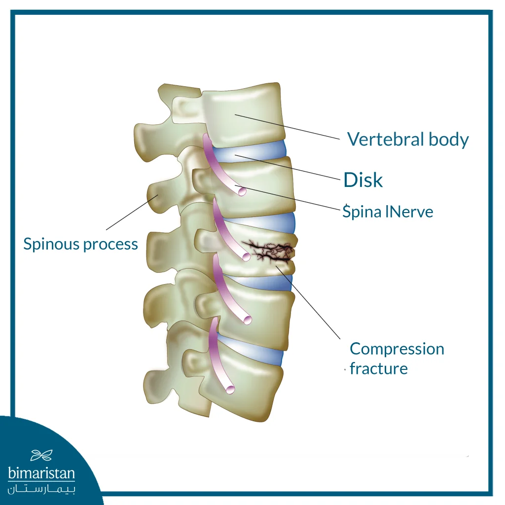 Image Showing A Compression Fracture Of The Spine