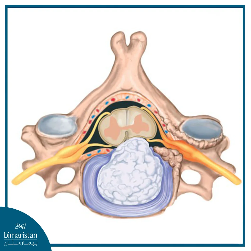 Image Showing A Herniated Disc And Compression Of The Spinal Cord