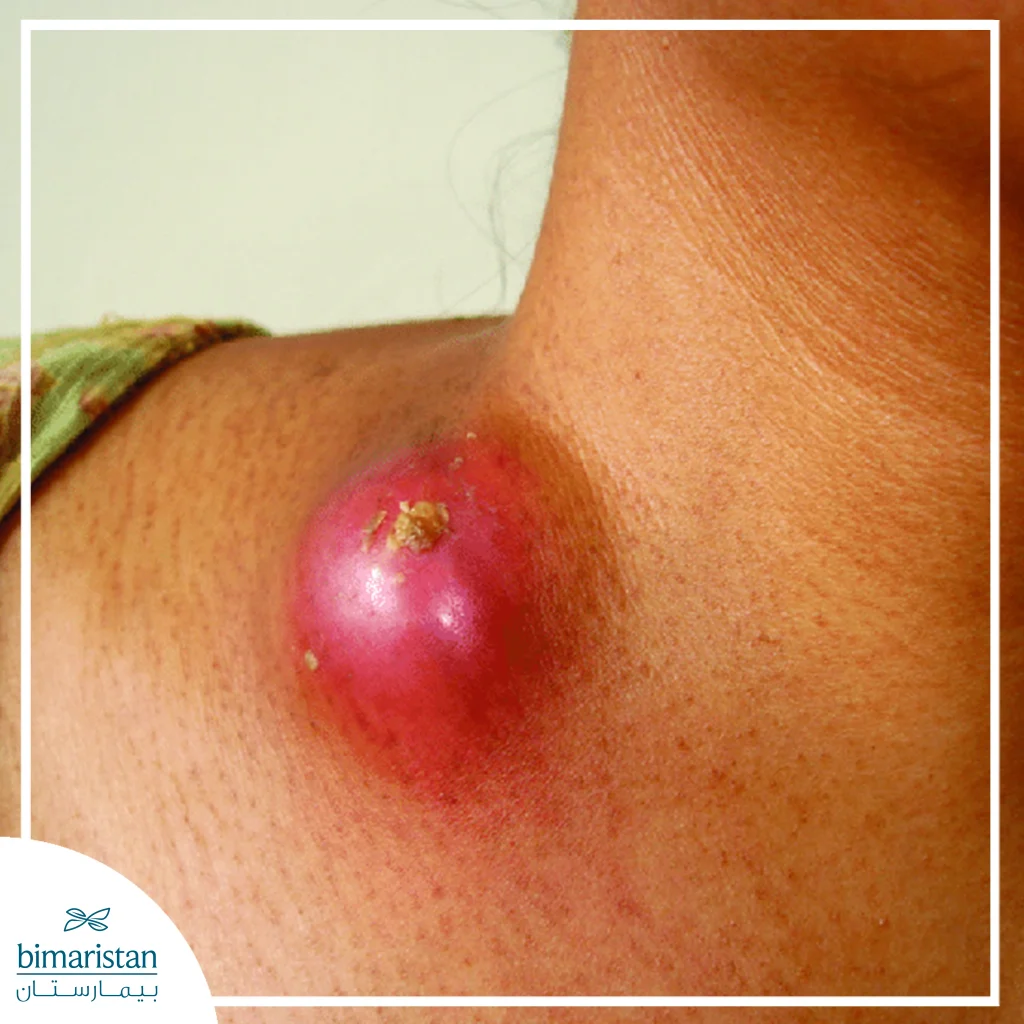 Extrapulmonary Tuberculosis: Types, Symptoms, And Different Treatment Methods 3 Image Showing A Neck Mass Caused By Tuberculous Lymph Node Tb