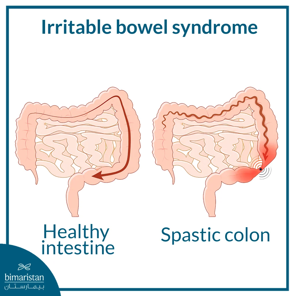 Image Showing Abnormal Intestinal Muscle Contractions In Irritable Bowel Syndrome (Ibs)