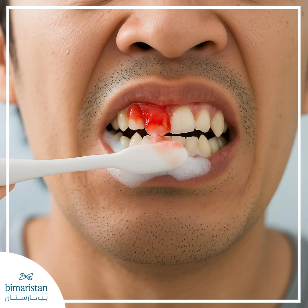Causes Of Bleeding Gums: A Simple Sign Or A Warning Sign Of A Serious Illness 3 Image Showing Bleeding Gums As A Result Of Brushing Teeth Too Vigorously.