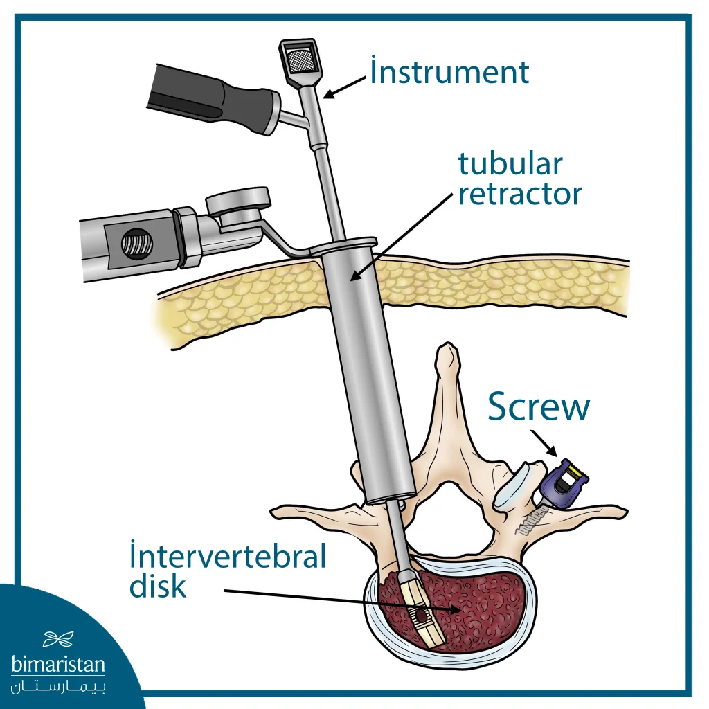 Image Showing How Minimally Invasive Surgery Is Performed