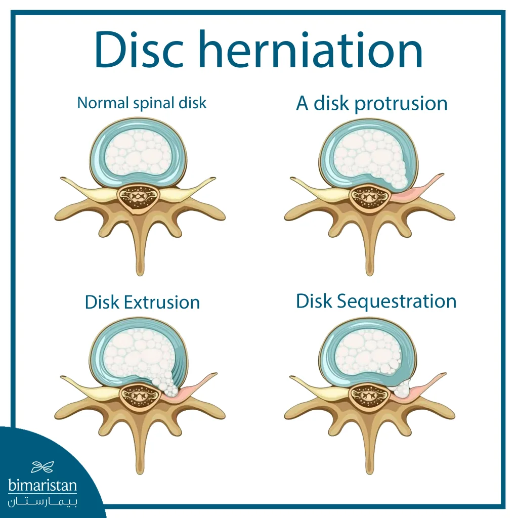 Disc Herniation Types: How Do Intervertebral Injuries Differ And Which Are The Most Serious? 5 Image Showing Some Types Of Disc Herniation