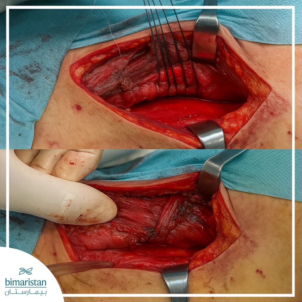 Image Showing Surgery For The Treatment Of Esophageal Perforation