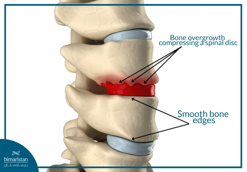 Image Showing The Difference Between Normal Vertebrae And Vertebrae With Bone Spurs