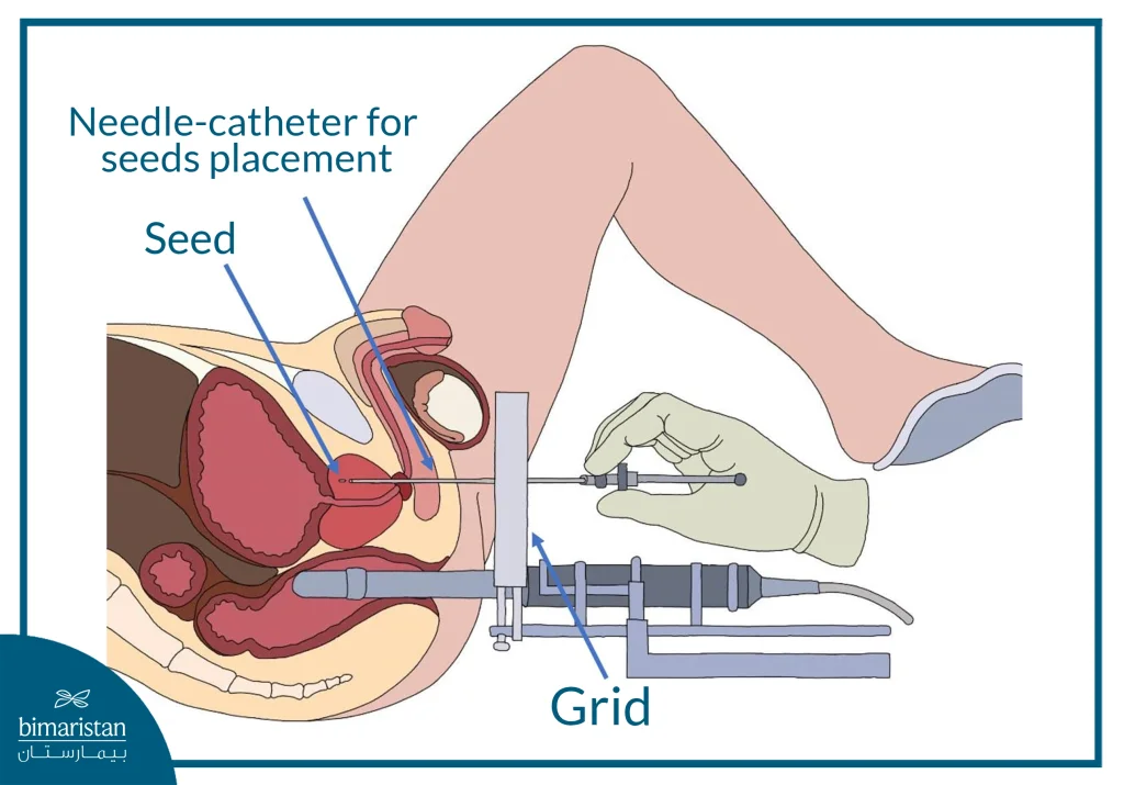 Image Showing The Mechanism Of Brachytherapy (Internal Radiation)