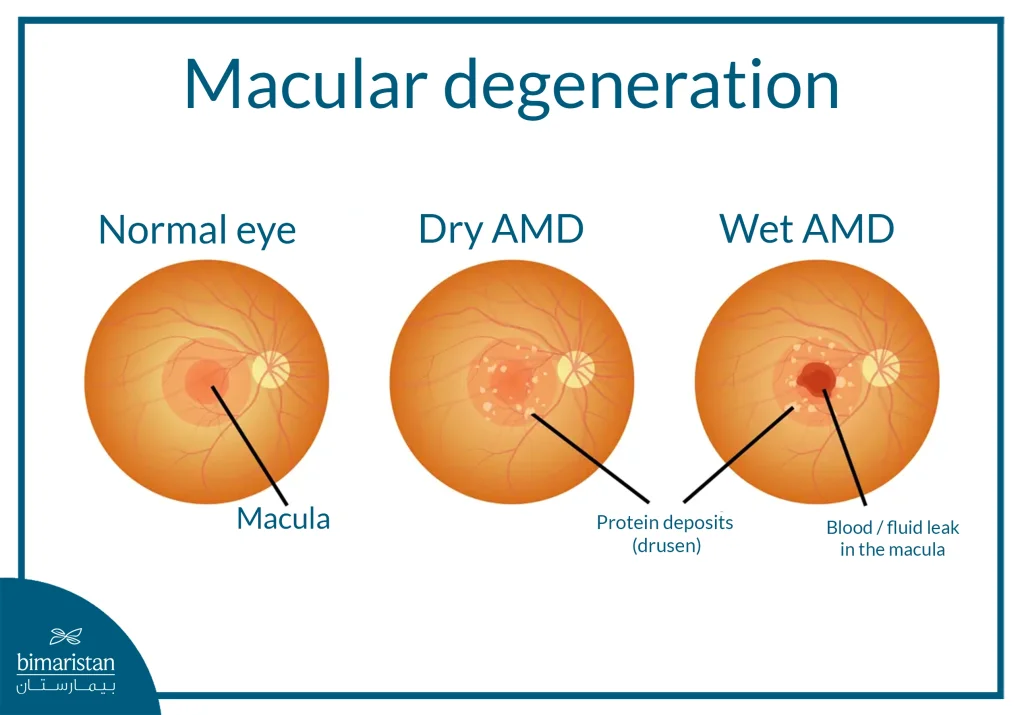 Image Showing The Types Of Macular Degeneration In The Eye
