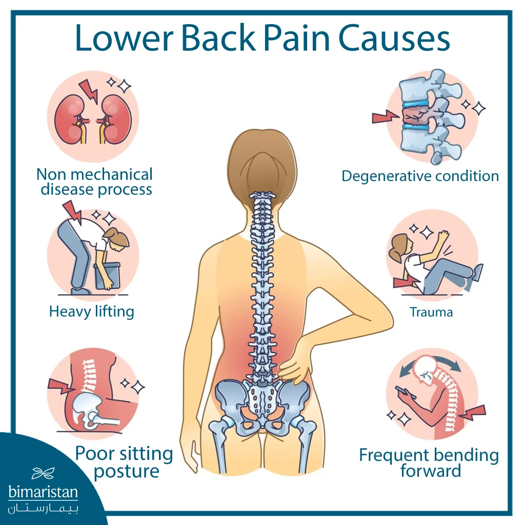 Back Pain Treatment: The Latest Medical Methods To Relieve Pain And Restore Mobility 2 Lower Back Pain Causes